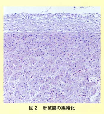 図2 肝被膜の線維化