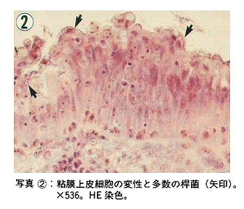 写真2 粘膜上皮細胞の変性と多数の桿菌