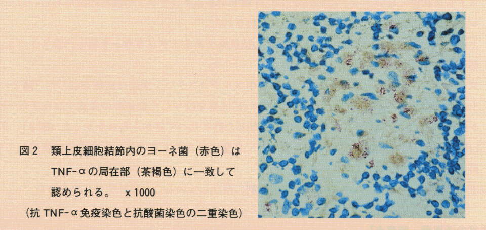 図2.類上皮細胞結節内のヨーネ菌はTNF-αの局在部に一致して認められる。