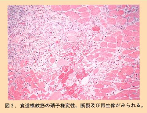 図2 食道横紋筋の硝子様変性、断裂および再生像が見られる