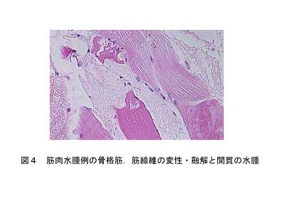 図4.筋肉水腫例の骨格筋、筋線維の変性・融解と間質の水腫