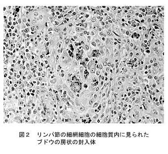 図2 リンパ節の細網細胞の細胞質内に見られたブドウの房状の封入体