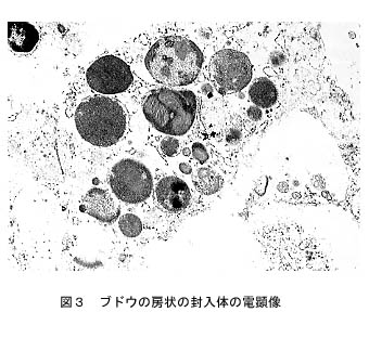 図3 ブドウの房状の封入体の電顕像