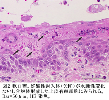 図2 軟口蓋。好酸性封入体(矢印)が水腫性変化ないし合胞体形成した上皮有棘細胞にみられる。Bar=50μm、HE染色。