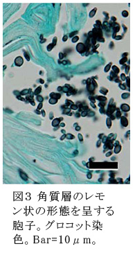 図3 角質層のレモン状の形態を呈する胞子。グロコット染色。Bar=10μm。