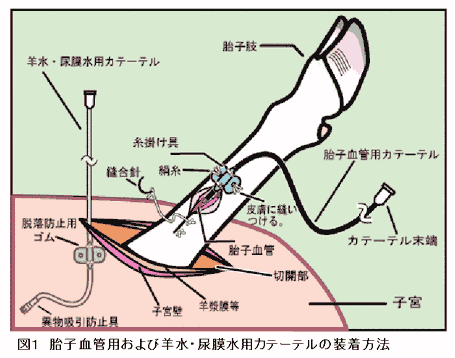 図1 胎子血管用および羊水・尿膜水用カテーテルの装着方法